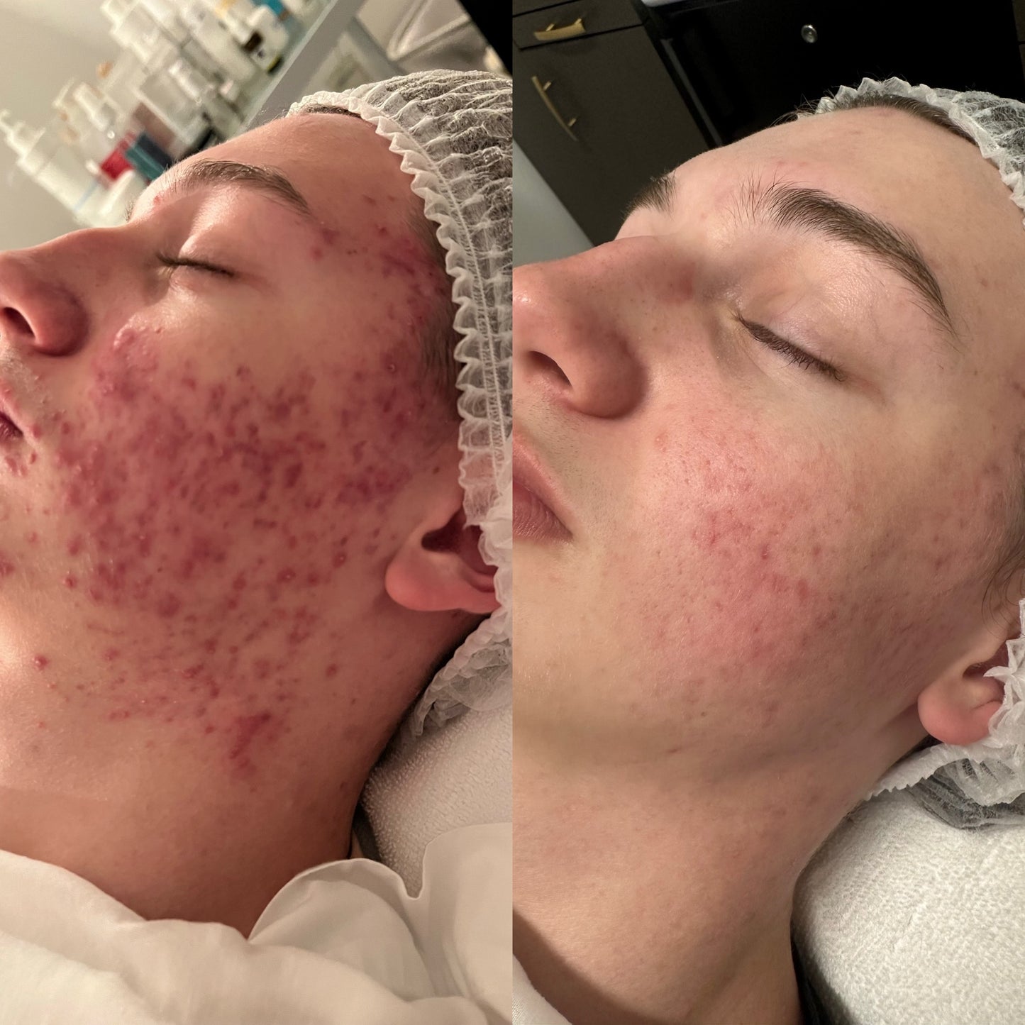 Acne Facial